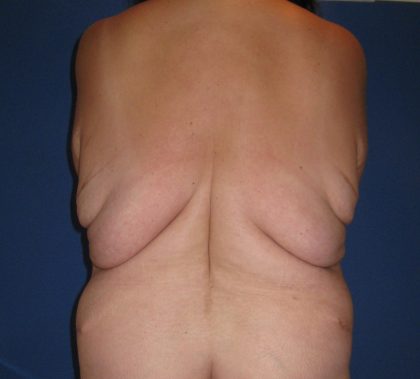 Upper Body Lift Before & After Patient #3643