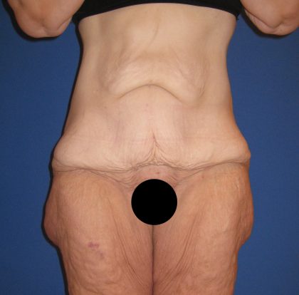 Tummy Tuck Before & After Patient #3373