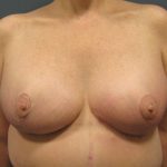 Breast Lift Before & After Patient #3430