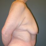 Breast Lift Before & After Patient #3430