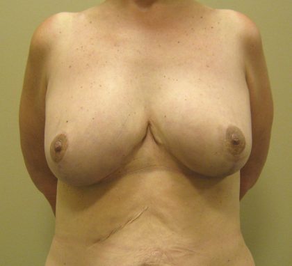 Breast Lift Before & After Patient #3422