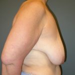 Breast Lift Before & After Patient #3422