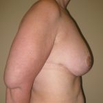 Breast Lift Before & After Patient #3422