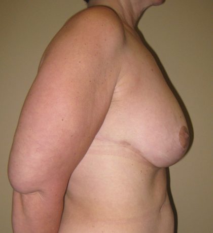 Breast Lift Before & After Patient #3422