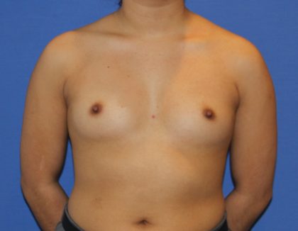 Breast Augmentation Before & After Patient #2658