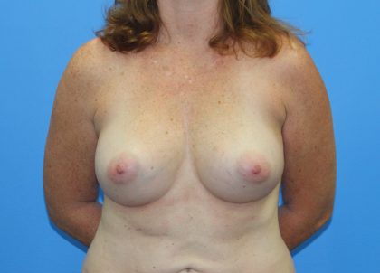 Breast Augmentation Before & After Patient #2707