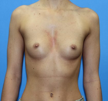 Breast Augmentation Before & After Patient #2714