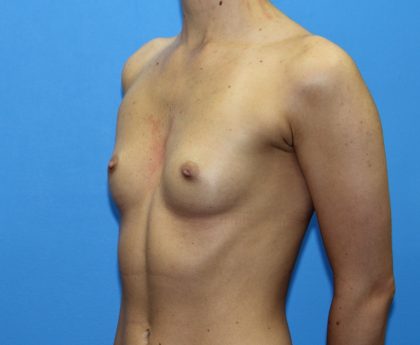 Breast Augmentation Before & After Patient #2714