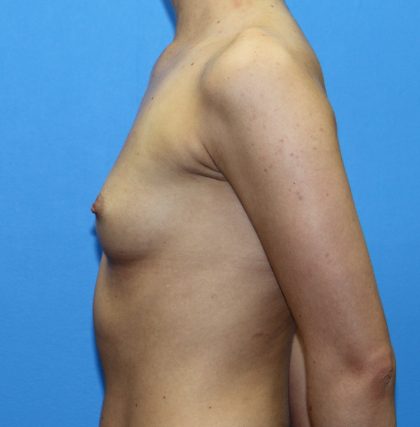 Breast Augmentation Before & After Patient #2714