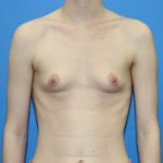 Breast Augmentation Before & After Patient #2700