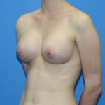 Breast Augmentation Before & After Patient #2700