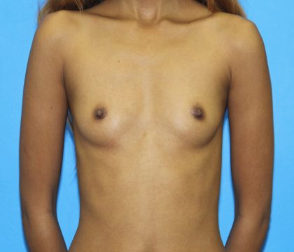 Breast Augmentation Before & After Patient #2679