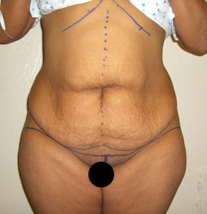 Tummy Tuck Before & After Patient #3380