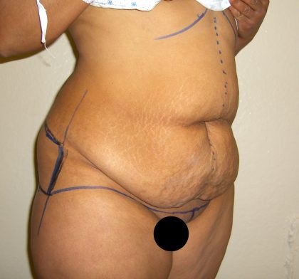 Tummy Tuck Before & After Patient #3380