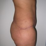 Tummy Tuck Before & After Patient #3380