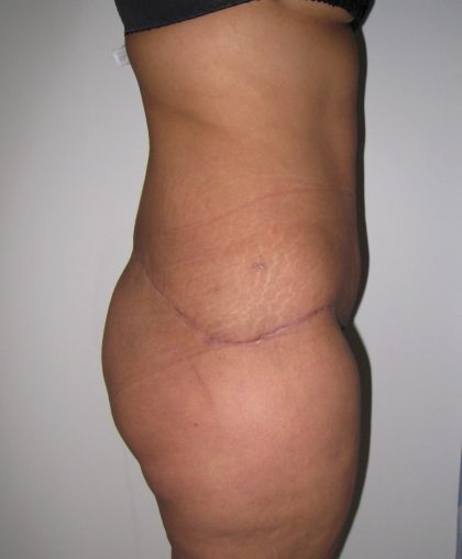 Tummy Tuck Before & After Patient #3380