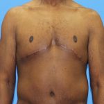 Gynecomastia Before & After Patient #2900