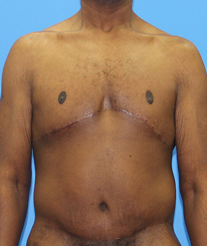 Gynecomastia Before & After Patient #2900