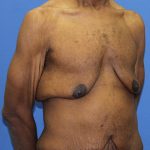 Gynecomastia Before & After Patient #2900