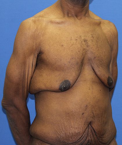 Gynecomastia Before & After Patient #2900