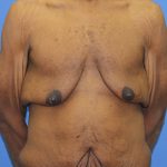 Gynecomastia Before & After Patient #2900