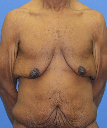 Gynecomastia Before & After Patient #2900