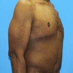 Gynecomastia Before & After Patient #2900