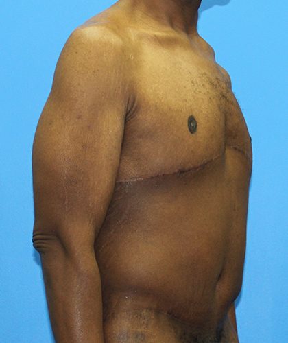 Gynecomastia Before & After Patient #2900