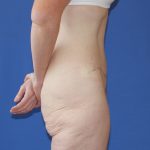 Tummy Tuck Before & After Patient #3172