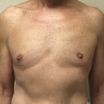 Gynecomastia Before & After Patient #2870