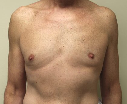 Gynecomastia Before & After Patient #2870