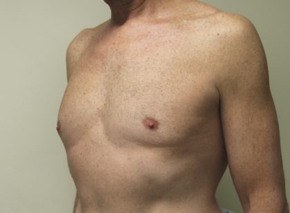 Gynecomastia Before & After Patient #2870