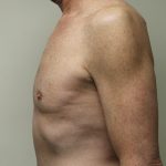 Gynecomastia Before & After Patient #2870