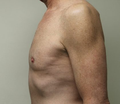 Gynecomastia Before & After Patient #2870