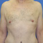 Gynecomastia Before & After Patient #2870