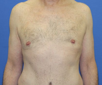 Gynecomastia Before & After Patient #2870