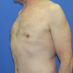 Gynecomastia Before & After Patient #2870