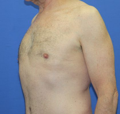 Gynecomastia Before & After Patient #2870