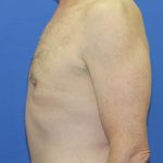 Gynecomastia Before & After Patient #2870