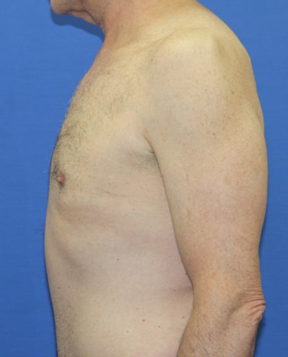 Gynecomastia Before & After Patient #2870