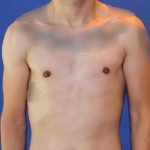 Gynecomastia Before & After Patient #2878