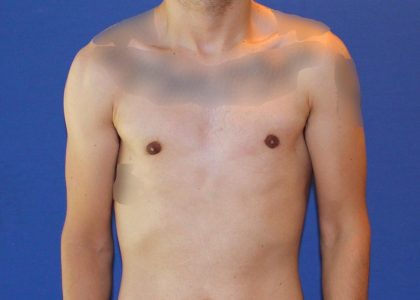 Gynecomastia Before & After Patient #2878