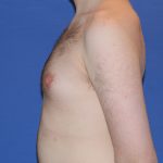 Gynecomastia Before & After Patient #2885