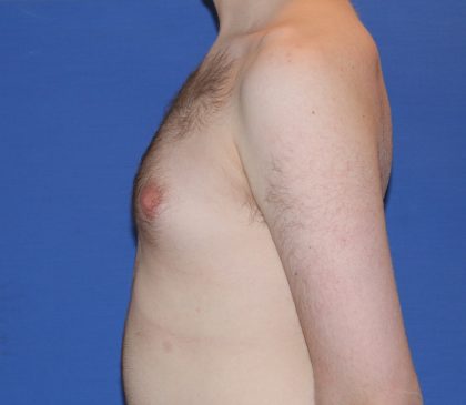 Gynecomastia Before & After Patient #2885