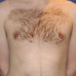 Gynecomastia Before & After Patient #2885