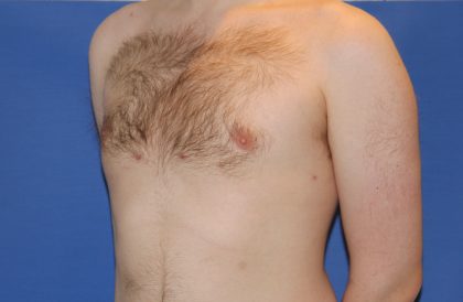 Gynecomastia Before & After Patient #2885