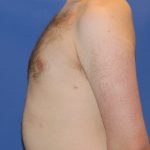 Gynecomastia Before & After Patient #2885