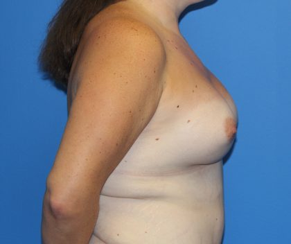 Breast Augmentation Before & After Patient #2763