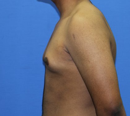 Gynecomastia Before & After Patient #2893