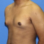 Gynecomastia Before & After Patient #2893